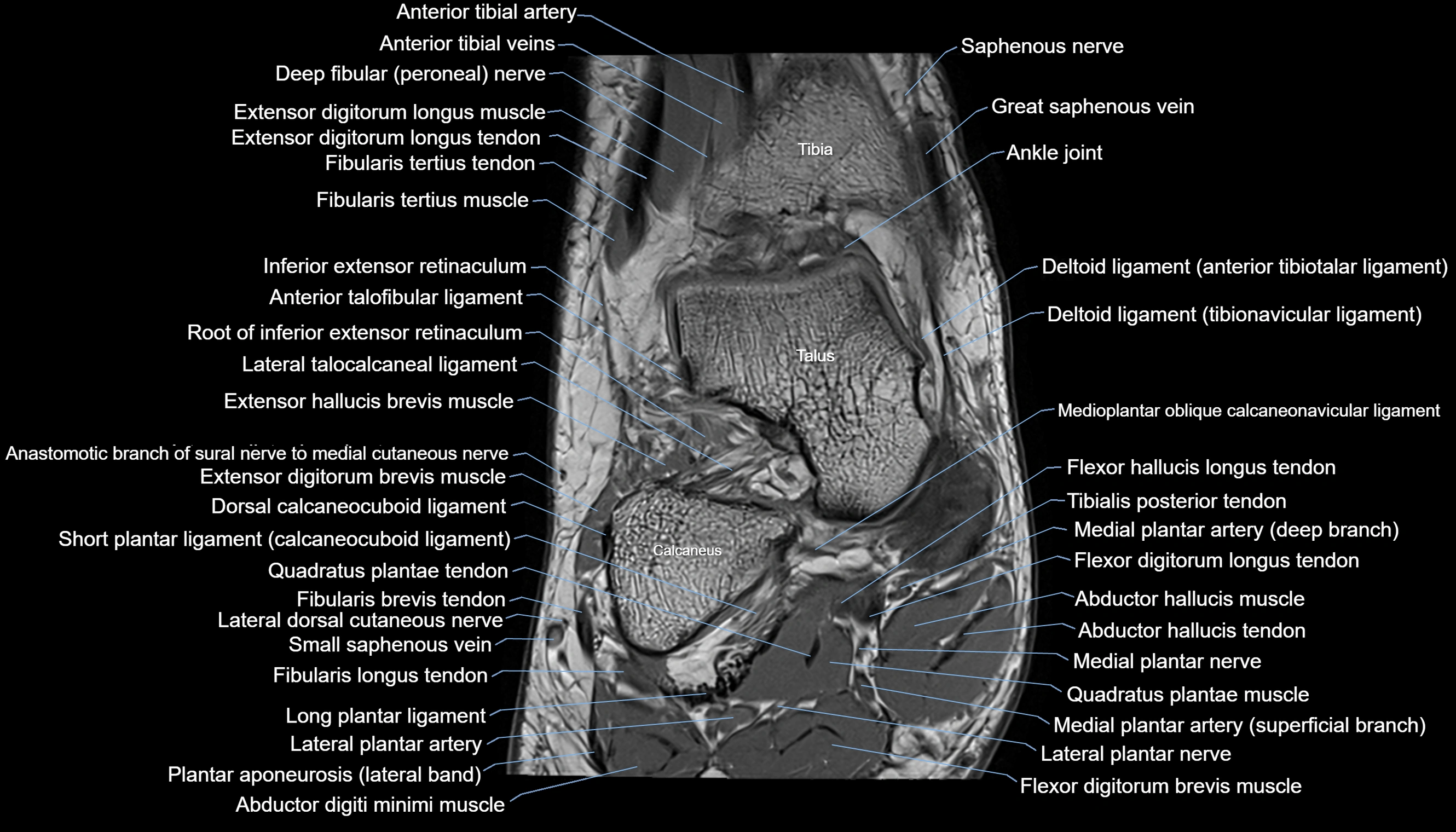 Ankle coronal anatomy 3T MRI images -img-11001-00006.webp